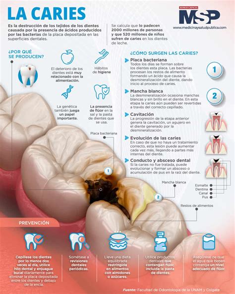 Infografia Caries En Caries Dental Escuela De Higiene Dental The Best