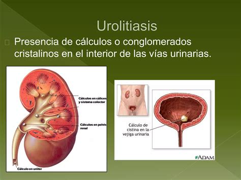 Hiperplasia Prost Tica Benigna C Ncer De Pr Stata Y Urolitiasis Ppt