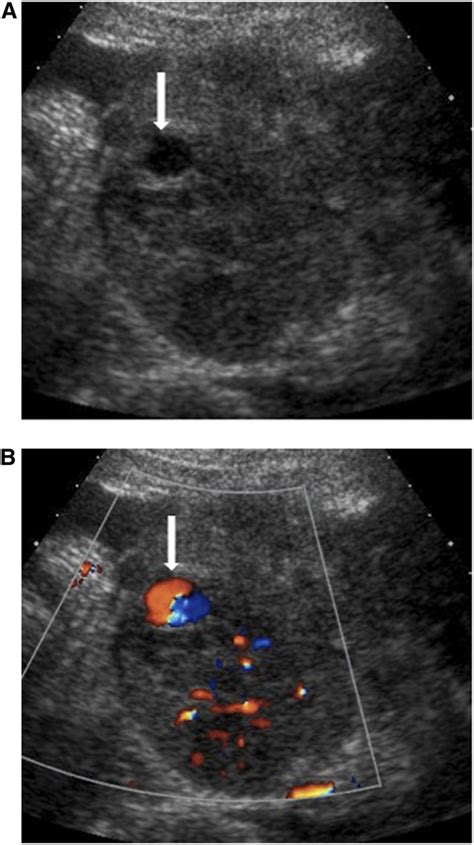 Doppler Ultrasonography Evaluation Of Postbiopsy Arteriovenous