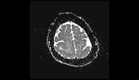 Pachygyria MRI | Radiology Article on Oligodendroglioma