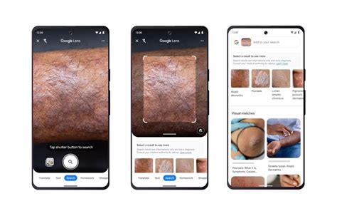 Google Lens Kini Bisa Deteksi Penyakit Kulit Pakai Ai Begini Caranya