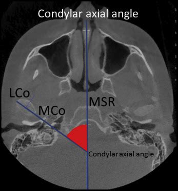 Idiopathic condylar resorptions: 3-dimensional condylar bony ...