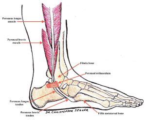 Peroneal Retinaculum Tear - Capital Physiotherapy