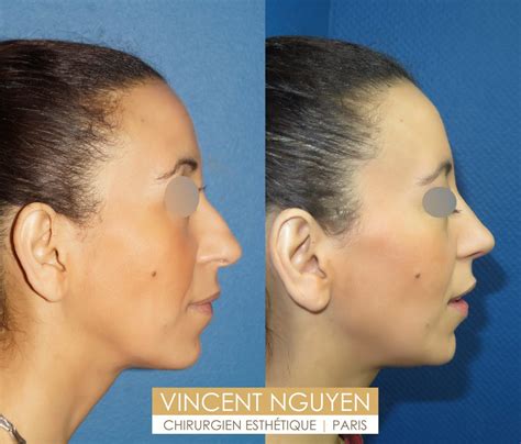 Rhinoplastie Paris Prix Chirurgie Esth Tique Et R Paratrice Du Nez