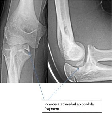 Medial epicondyle fracture that is incarcerated following closed... | Download Scientific Diagram