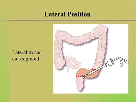 Laparoscopic Sigmoid Colon Resection Supine And Lateral