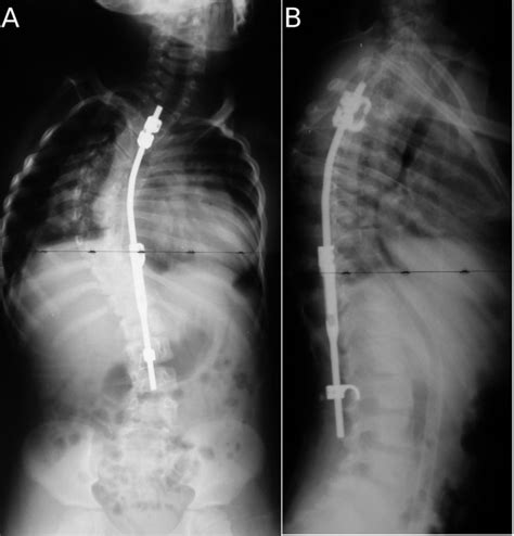 A B Case 4 Postoperative Radiographs Anteroposterior A And Download Scientific Diagram