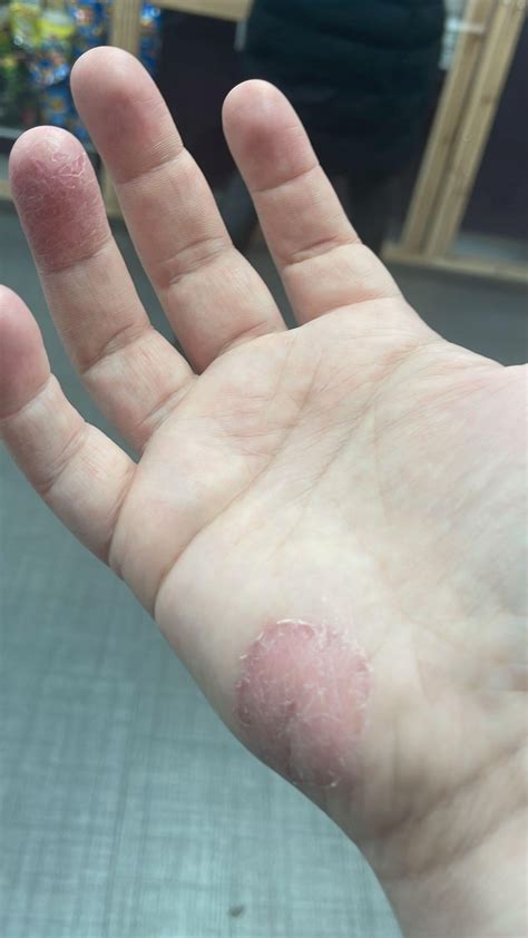 Growing Patch Of Dry Sore Skin On Palm Of Hand 🖐 R Dermatologyquestions