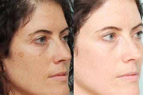 What are these Brown Spots on Face and How to Treat Them - HerGamut