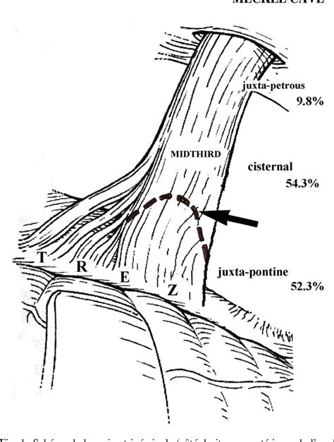 Figure 1 From Neurochirurgie Fonctionnelle Dans Les Syndromes D