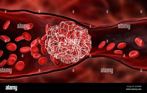 Coágulo De Sangre O Trombo Que Bloquea El Flujo De Glóbulos Rojos Dentro De Una Arteria O Una