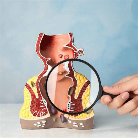 Dont Ignore These Warning Signs Of Anal Fissures Chandler AZ