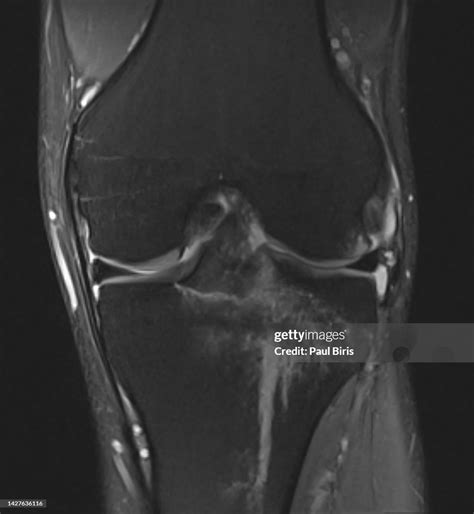 Anterior Cruciate Ligament Avulsion Fracture Or Tibial Eminence Avulsion Fracture Seen On Mri