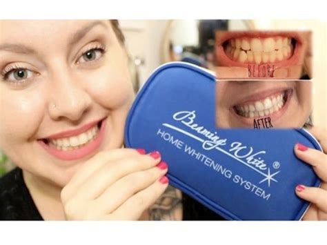 Deluxe Home Teeth Whitening Kit Beaming White Smile Reviews Teethwalls