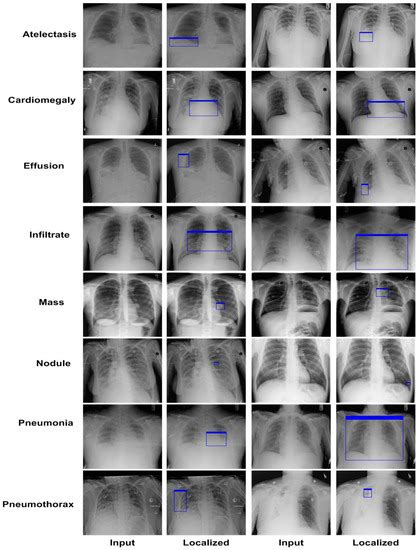 CXray EffDet Chest Disease Detection And Classification From X Ray