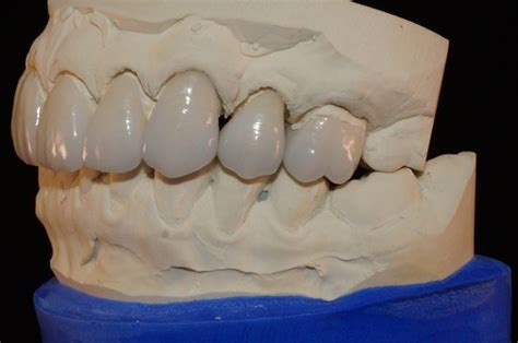 IPS E Max Porcelain Crowns Olivadds Dental Restoration