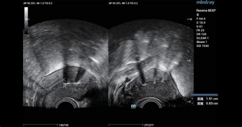 Ultrasound Journal 4 Ultrasound Assessment Of Intrauterine Device