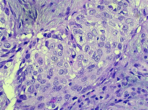 Squamous Cell Carcinoma Anus Kiko Xp