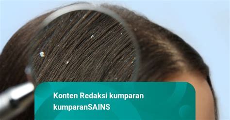 Kenapa Rambut Bisa Berketombe Ketahui Cara Mengatasinya Kumparan