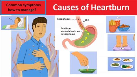 Causes of Heartburn, common symptoms, how to manage? - Helal Medical