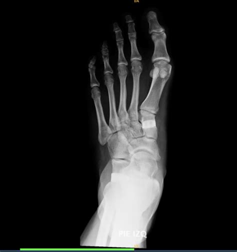 6 Years Of Sesamoiditis Rsesamoid