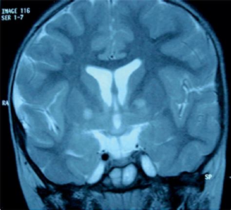 Figure 2 From Unilateral Absence Of Sphenoid Wing In A