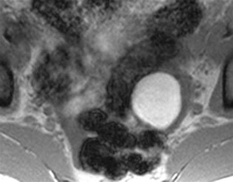 Endometriosis Imaging Mri at Lisa Bean blog