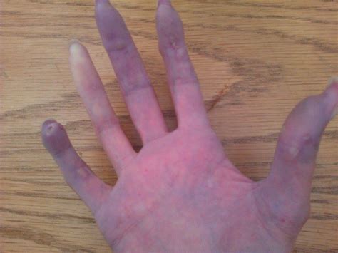 Scleroderma And Handling Raynaud S Digital Ulcers