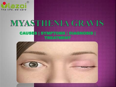 Myasthenia Gravis Symptoms Causes Diagnosis And Treatment