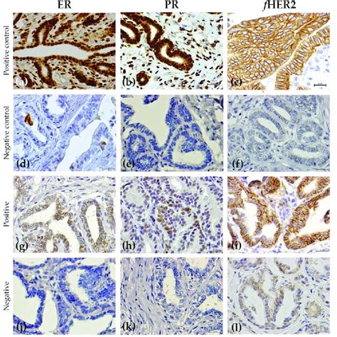 Immunohistochemical Expression Of The Different Proteins Studied In