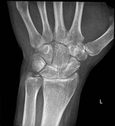 Chondrocalcinosis Image Radiopaedia Org