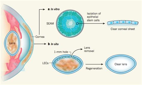 Remarkable Surgery Uses Stem Cells To Regenerate An Eyes Lens And