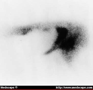 Cholescintigraphy
