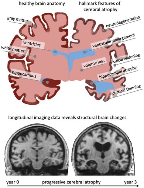 Frontiers Brain Shape Changes Associated With Cerebral Atrophy In