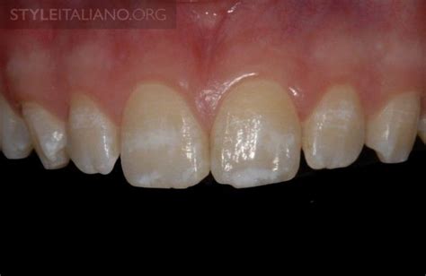 Conservative Treatment Of Fluorosis And Post Orthodontic White Spots