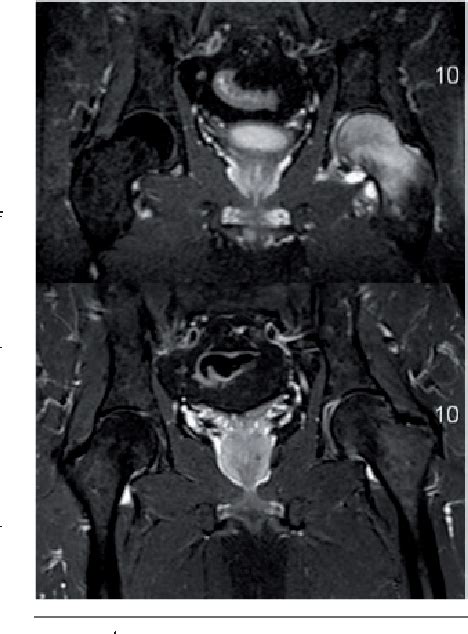 Figure 1 From Magnetic Resonance Imaging Of Hip Joint Cartilage And Labrum Semantic Scholar