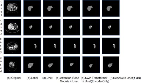 Csse Free Full Text Liver Tumor Segmentation Based On Multi Scale