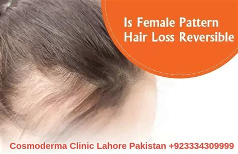 Female Pattern Hair Loss Treatment In Lahore Pakistan Best Options