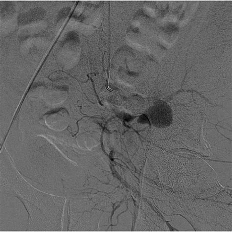 Ct Demonstrating The Pseudoaneurysm Of Left Superior Gluteal Artery And