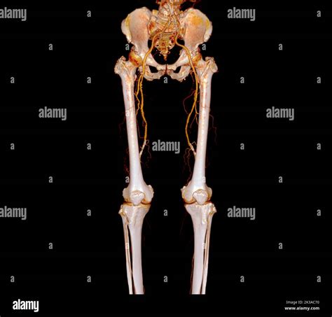 Cta Femoral Artery Run Off 3d Rendering Image Of Femoral Artery