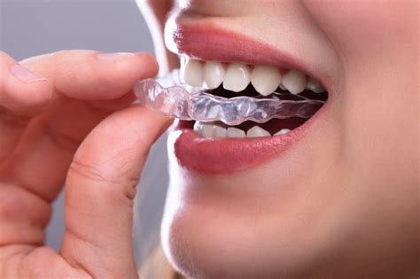 How Orthosnap Can Save You Money Compared To Other Clear Aligners