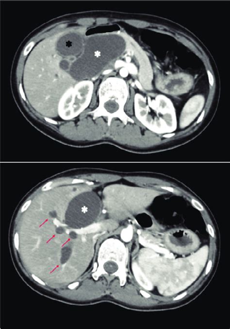 Ct Scan Showing Dilatated Common Bile Duct White Asterisk With