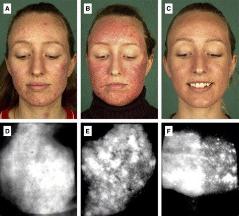 References In Photodynamic Therapy Of Acne Vulgaris Using 5 Aminolevulinic Acid Versus Methyl