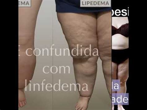 O Que O Lipedema Youtube