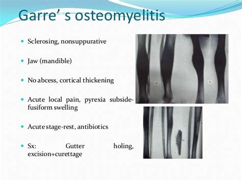 Osteomyelitis