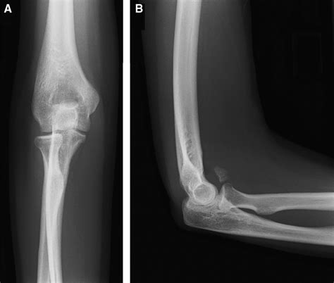 Isolated Anterolateral Fracture Of The Coronoid Process Of The Ulna A Case Report Journal Of