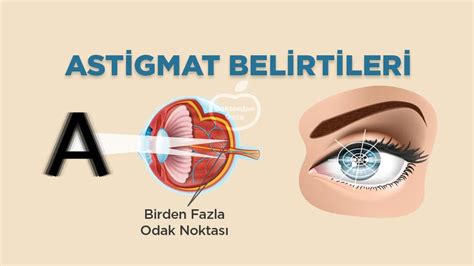 Astigmat Nedir Nedenleri ve Belirtileri Doktordan Önce