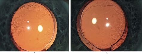 Figure 1 From Severe Photic Phenomenon Semantic Scholar