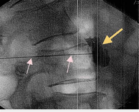 Left L5 S1 Lumbar Sympathetic Nerve Block In Lateral View The Image