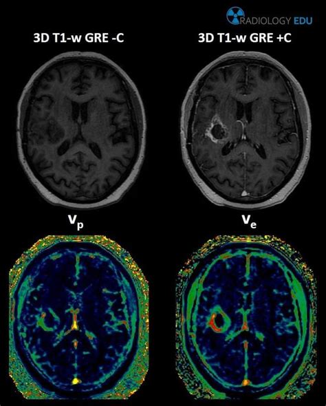 Dynamic Contrast Enhanced Perfusion Weighted Imaging Dce Pwi